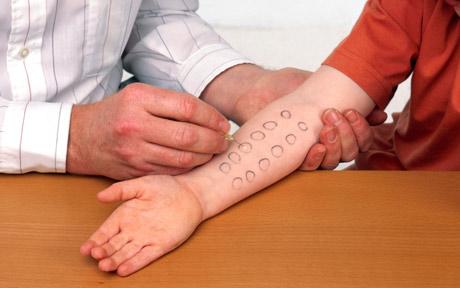 prick test Allergie crociate